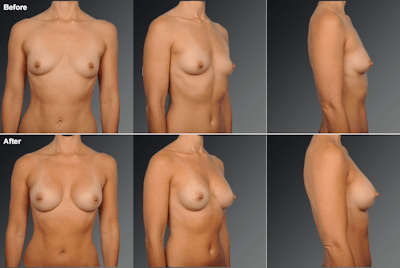 Breast Augmentation Before & After Gallery - Patient 161354 - Image 1