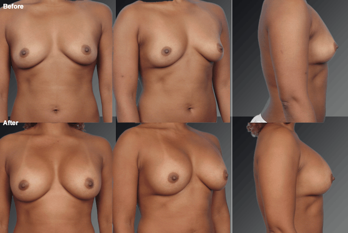 Breast Augmentation Before & After Gallery - Patient 114925 - Image 1