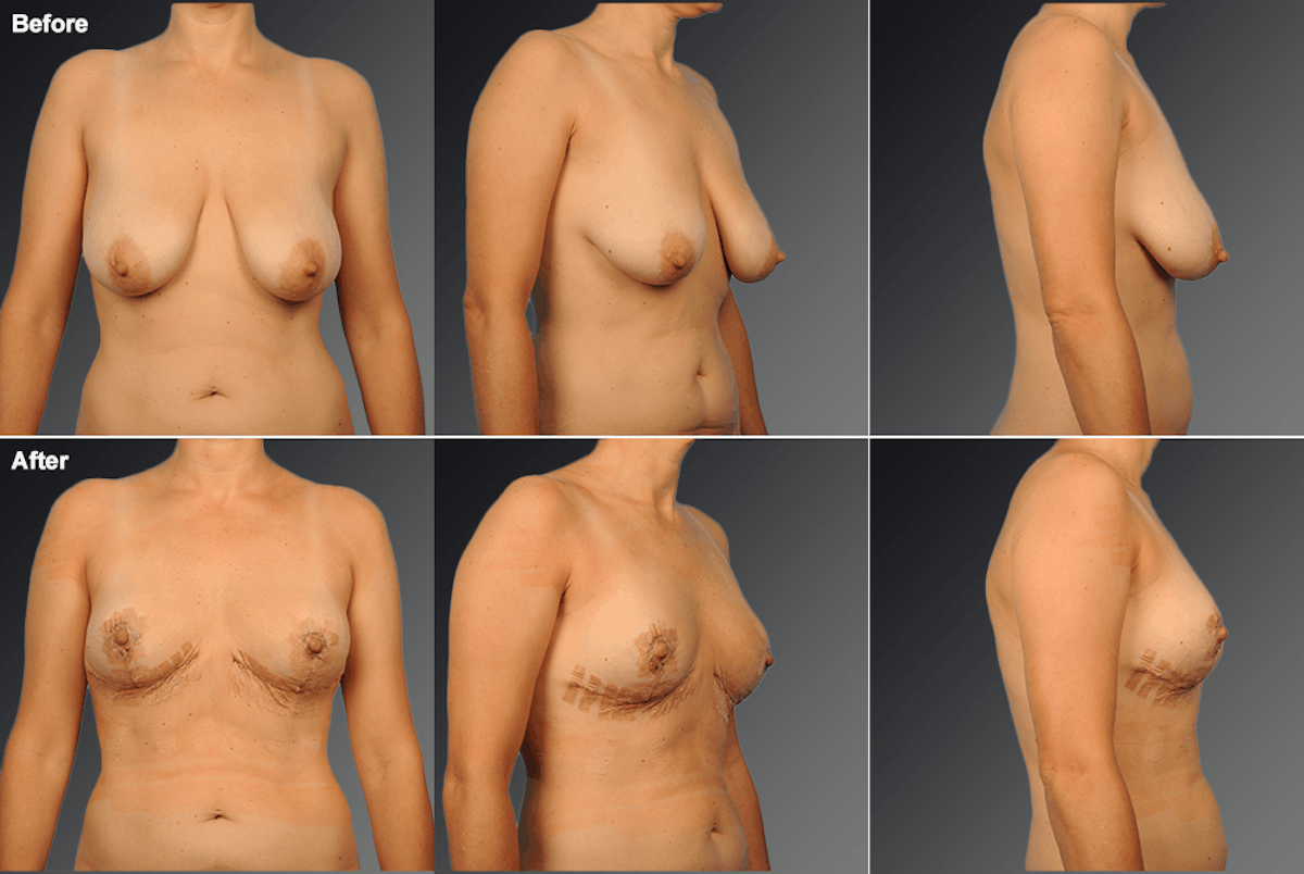 Breast Lift (Mastopexy) Before & After Gallery - Patient 309271 - Image 1