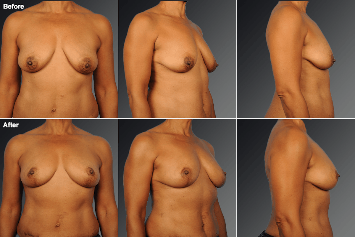 Breast Lift (Mastopexy) Before & After Gallery - Patient 137338 - Image 1