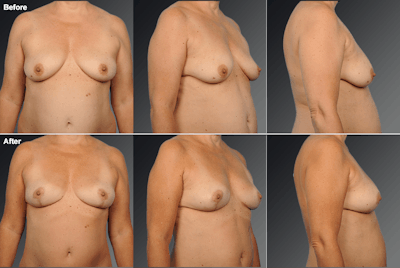 Explantation Before & After Gallery - Patient 328225 - Image 1