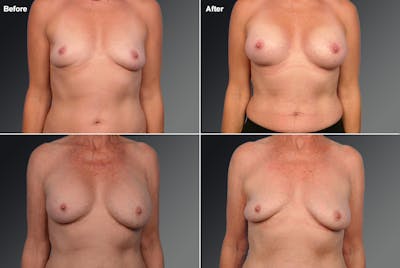 Explantation Before & After Gallery - Patient 223894 - Image 1