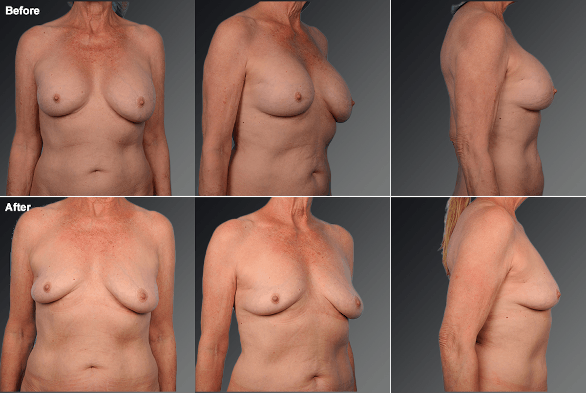 Explantation Before & After Gallery - Patient 297821 - Image 1