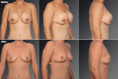 Deflation Before & After Gallery - Patient 285833 - Image 1