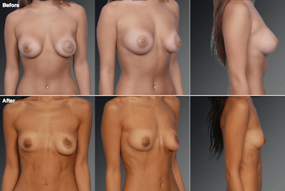 Breast Augmentation with Donut Lift Before & After Gallery - Patient 382466 - Image 1