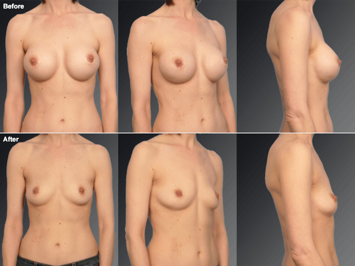 Explantation Before & After Gallery - Patient 123112 - Image 1