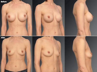 Explantation Before & After Gallery - Patient 163125 - Image 1