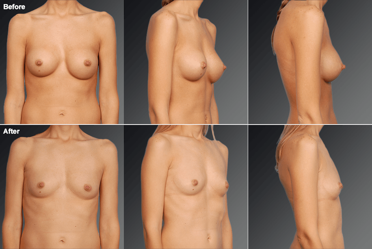 Explantation Before & After Gallery - Patient 143525 - Image 1