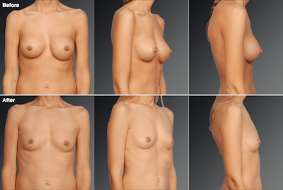 Explantation Before & After Gallery - Patient 143525 - Image 1