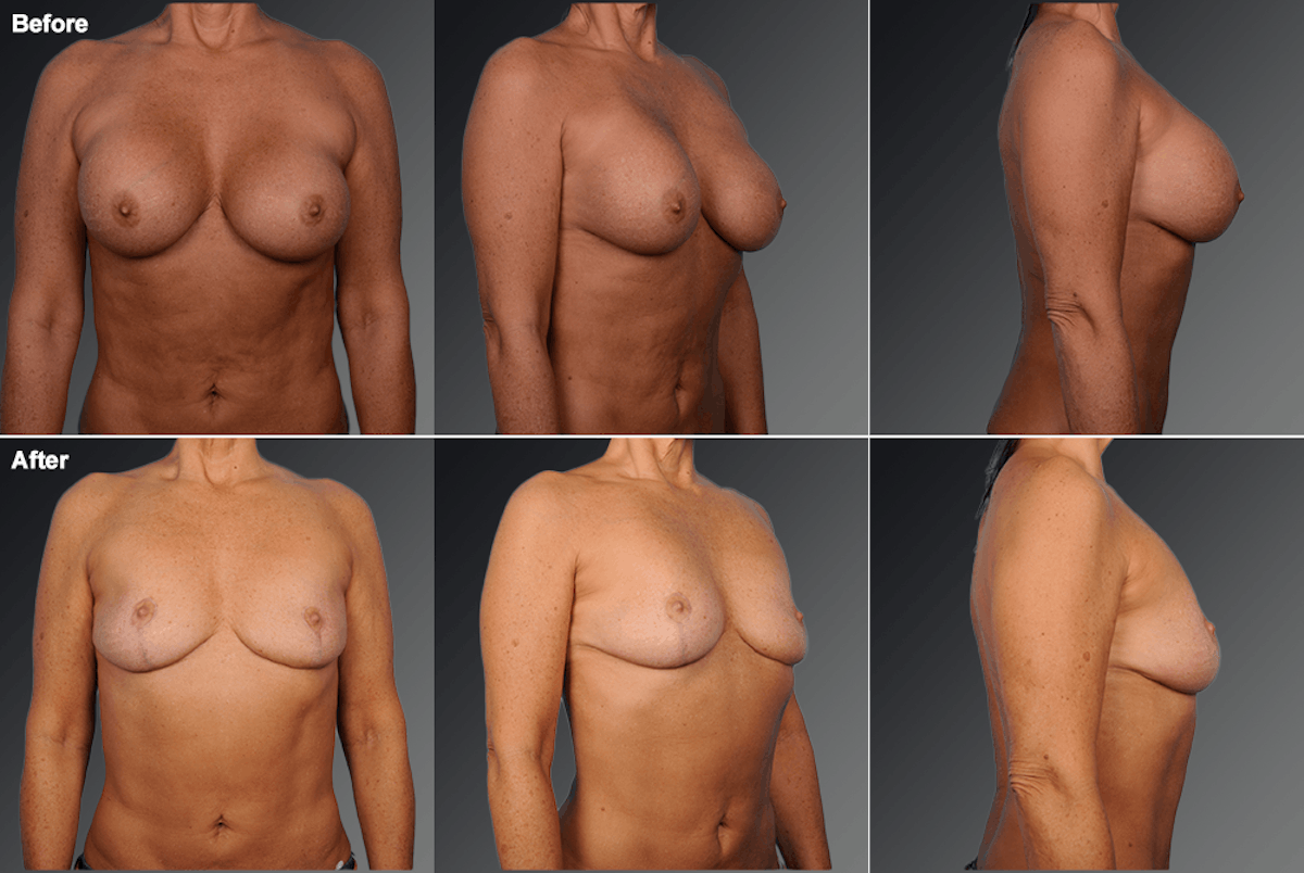 Explantation Before & After Gallery - Patient 110293 - Image 1