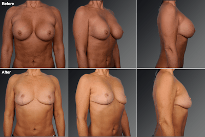 Explantation Before & After Gallery - Patient 110293 - Image 1