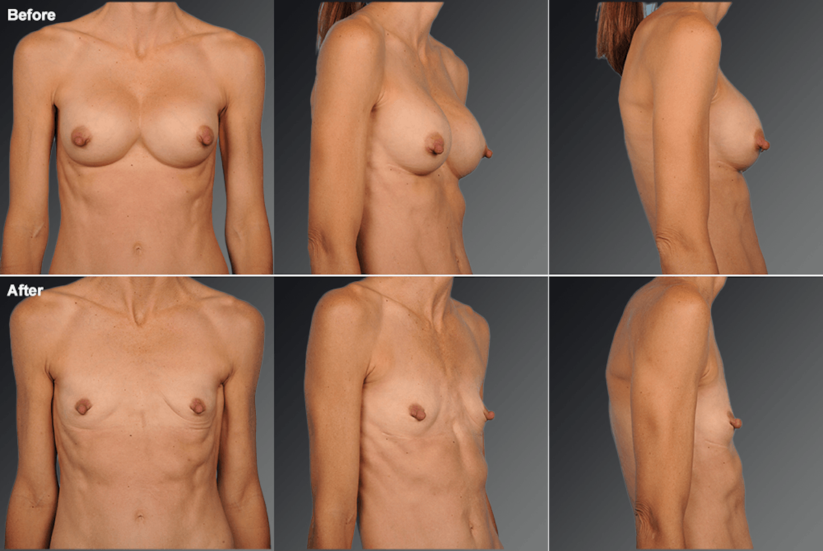 Explantation Before & After Gallery - Patient 284100 - Image 1