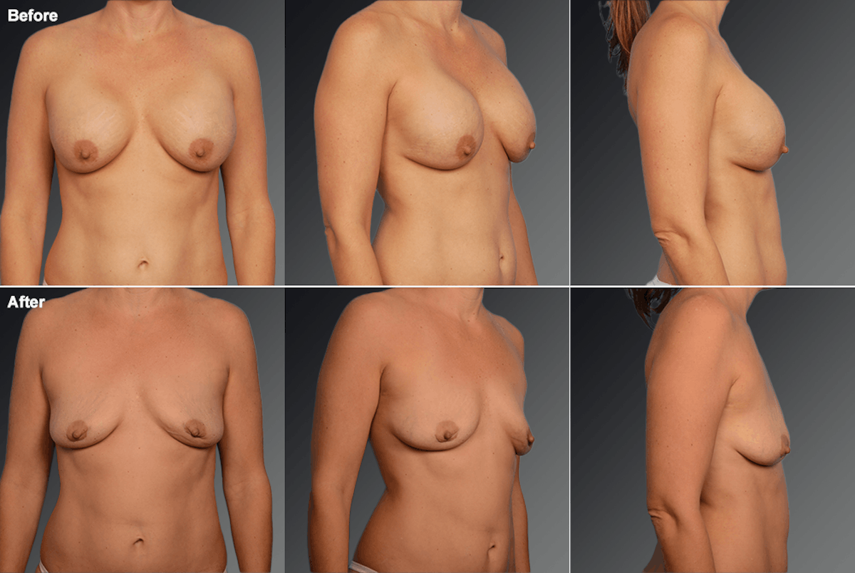Explantation Before & After Gallery - Patient 355383 - Image 1