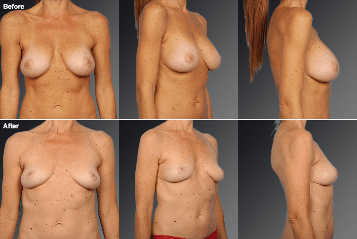 Explantation Before & After Gallery - Patient 258966 - Image 1