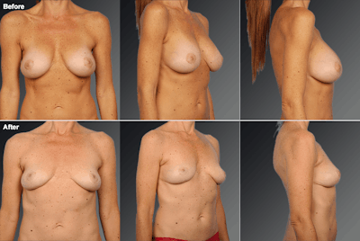 Explantation Before & After Gallery - Patient 258966 - Image 1