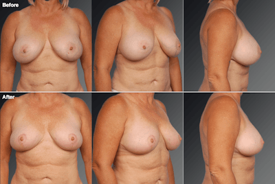 Explantation Before & After Gallery - Patient 231272 - Image 1