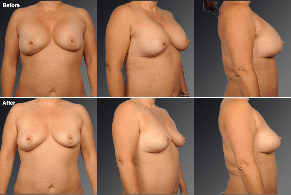 Explantation Before & After Gallery - Patient 742696 - Image 1