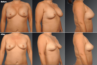 Explantation Before & After Gallery - Patient 212472 - Image 1