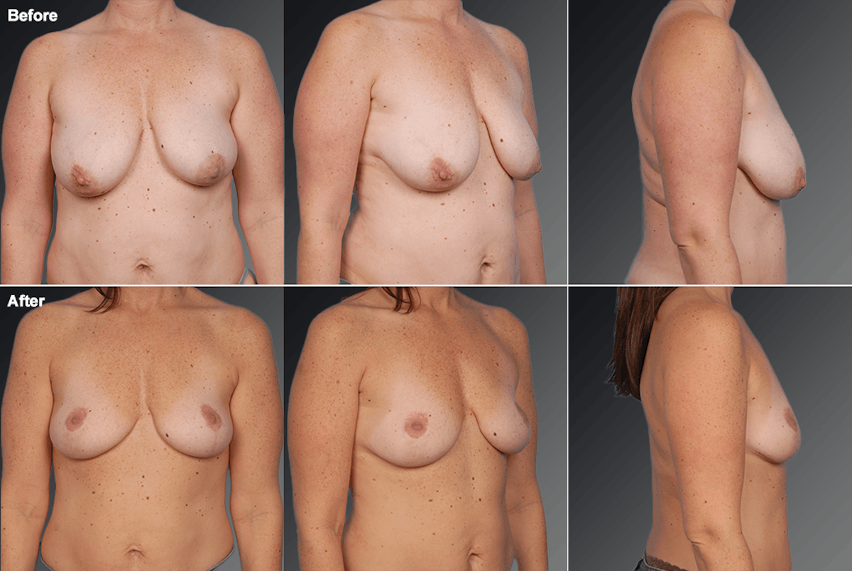 Explantation Before & After Gallery - Patient 233937 - Image 1