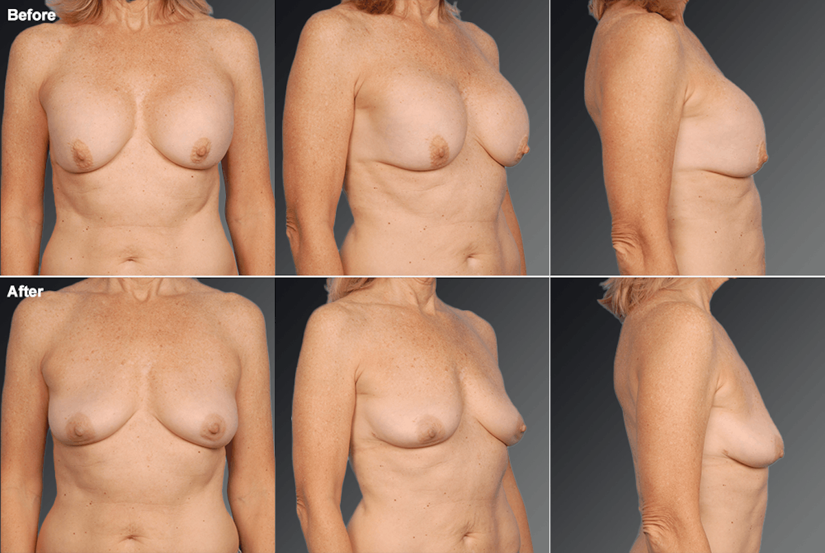 Explantation Before & After Gallery - Patient 198183 - Image 1