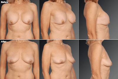 Explantation Before & After Gallery - Patient 771587 - Image 1