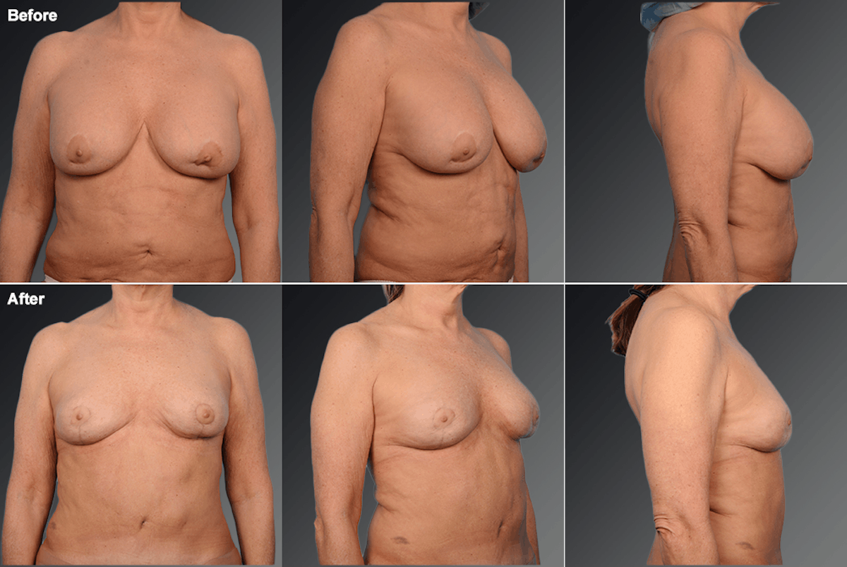 Explantation Before & After Gallery - Patient 141329 - Image 1