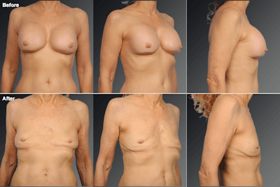 Explantation Before & After Gallery - Patient 827791 - Image 1