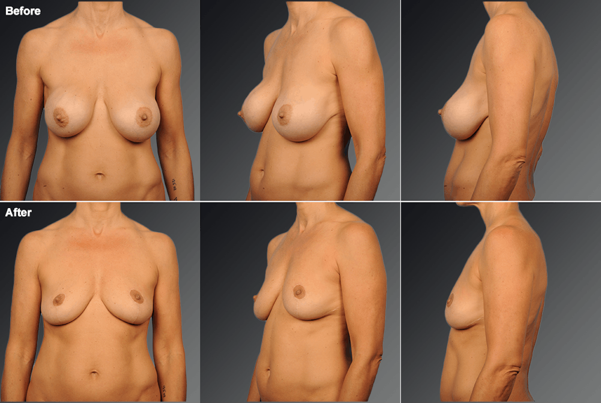 Explantation Before & After Gallery - Patient 205015 - Image 1