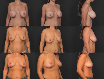 Explantation Before & After Gallery - Patient 166520 - Image 1