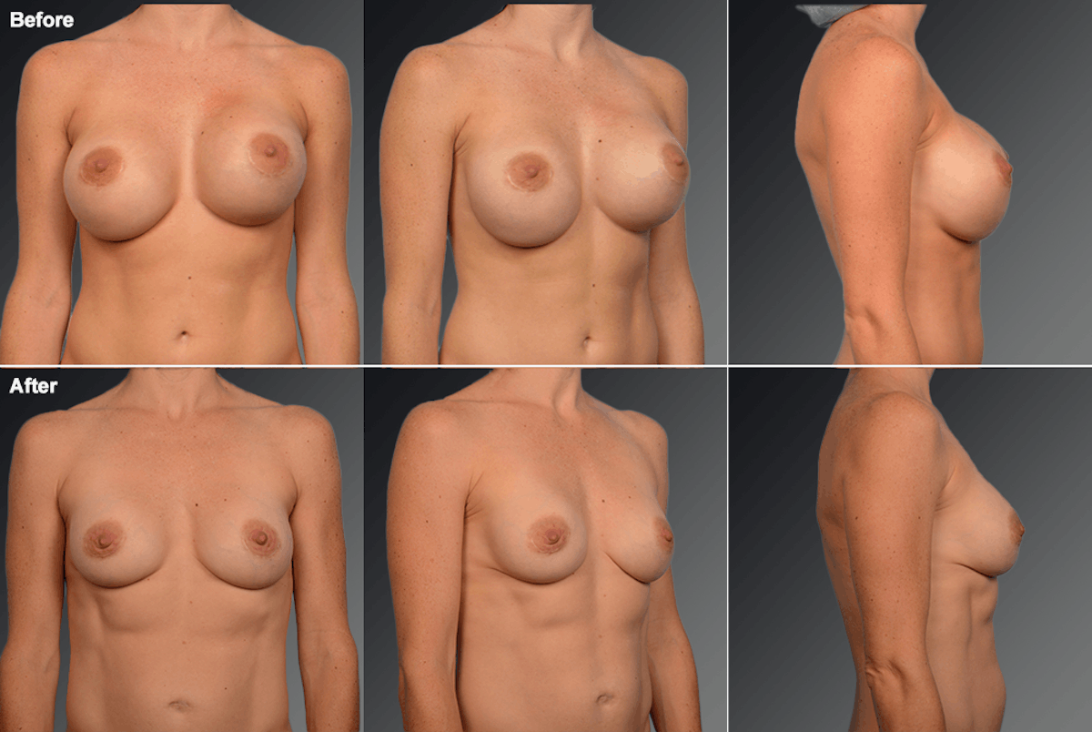 Explantation Before & After Gallery - Patient 169363 - Image 1