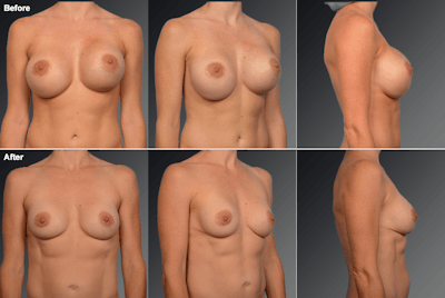 Explantation Before & After Gallery - Patient 361189 - Image 1