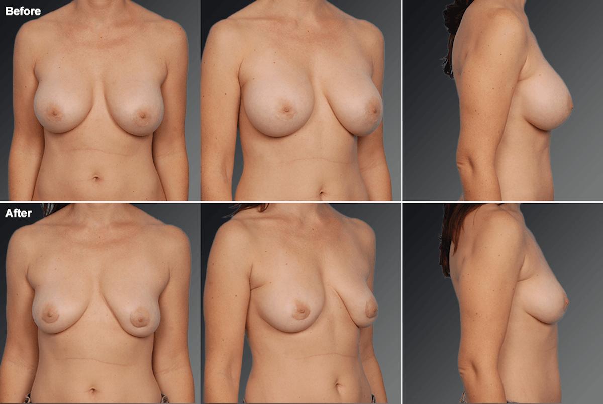 Explantation Before & After Gallery - Patient 101030 - Image 1