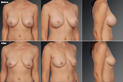 Explantation Before & After Gallery - Patient 187971 - Image 1