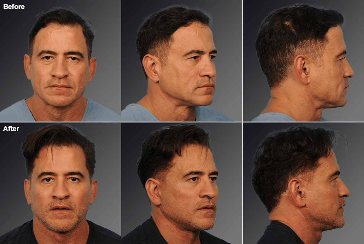 Face Before & After Gallery - Patient 153586 - Image 1