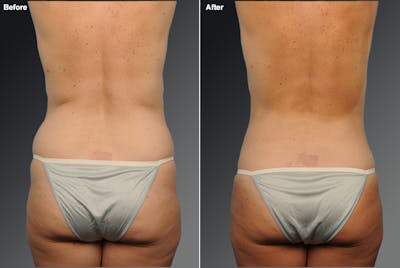 Liposuction Before & After Gallery - Patient 145521 - Image 1