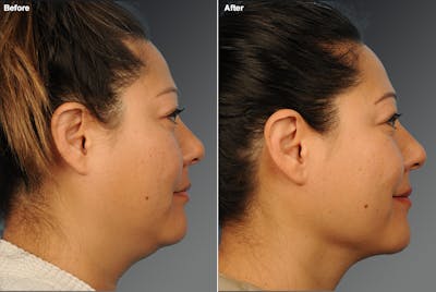 Liposuction Before & After Gallery - Patient 396785 - Image 1