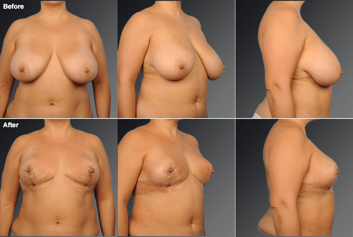 Breast Reduction Before & After Gallery - Patient 397691 - Image 1