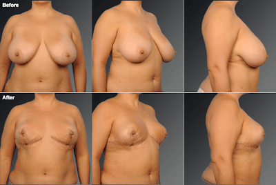 Breast Reduction Before & After Gallery - Patient 397691 - Image 1