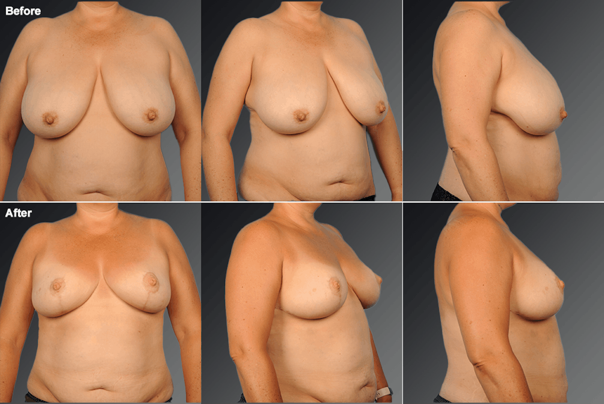 Breast Reduction Before & After Gallery - Patient 243268 - Image 1