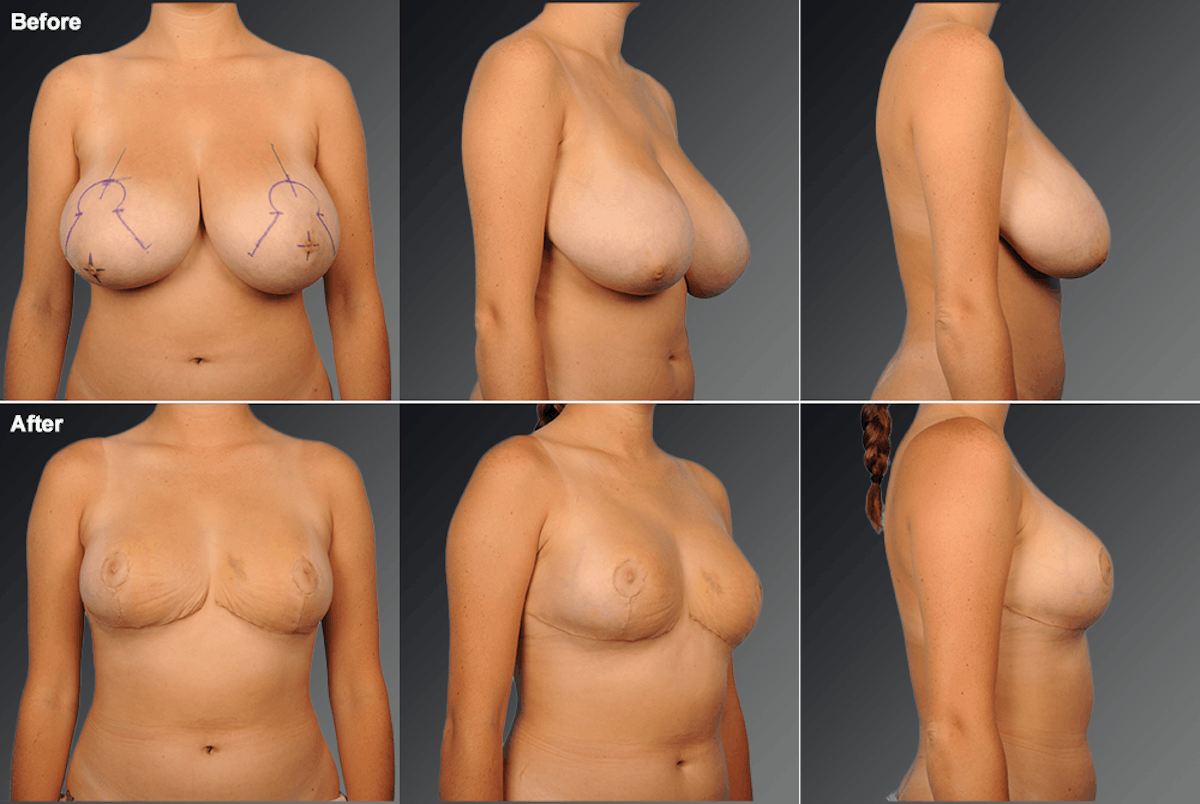 Breast Reduction Before & After Gallery - Patient 261456 - Image 1