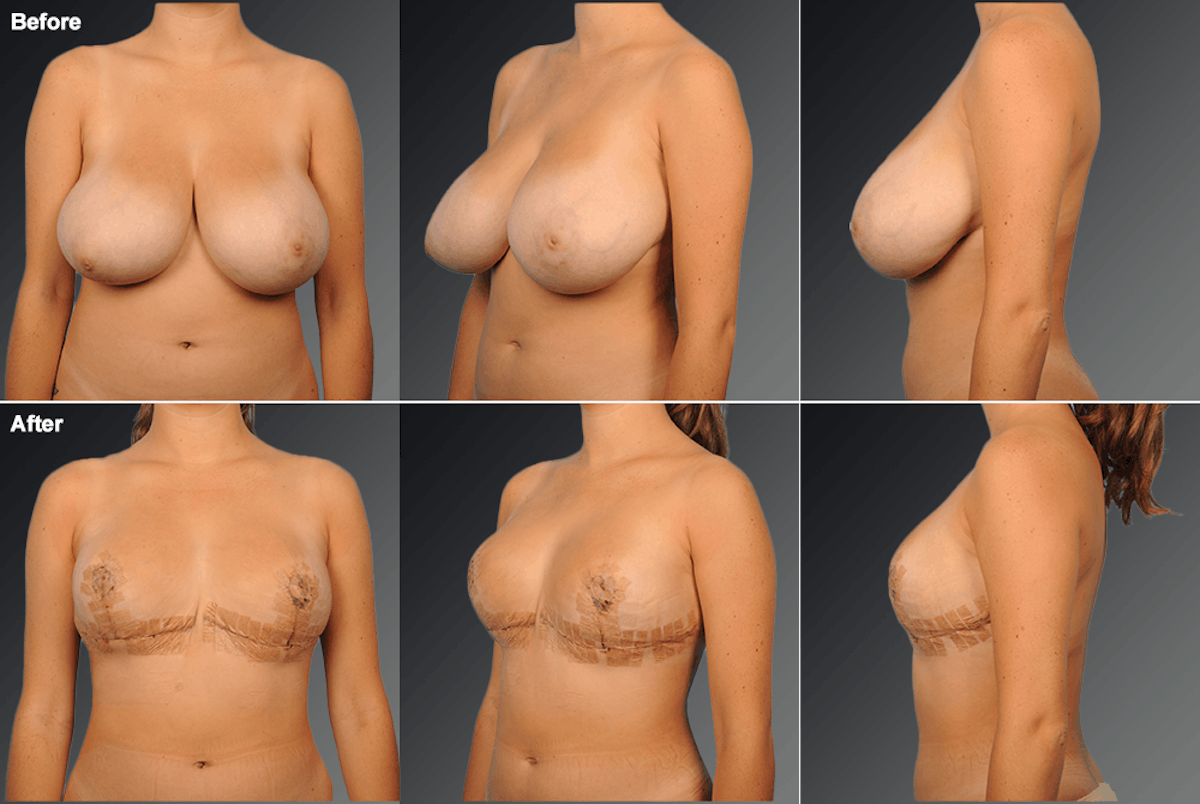 Breast Reduction Before & After Gallery - Patient 895562 - Image 1