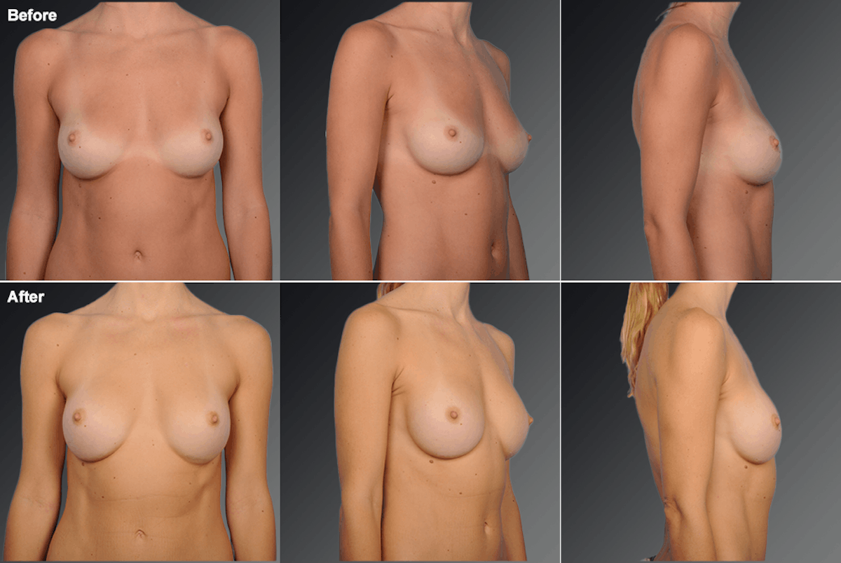 Breast Implant Revision Before & After Gallery - Patient 360014 - Image 1