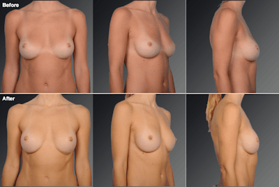 Breast Implant Revision Before & After Gallery - Patient 360014 - Image 1