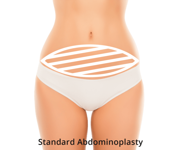 Graphic of Abdominoplasty