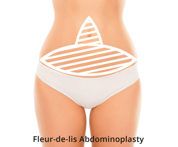 Graphic of Abdominoplasty