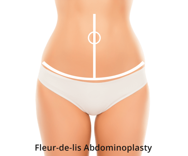 Graphic of a Fleur De Lis Abdominoplasty