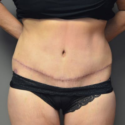 Abdominoplasty (Tummy Tuck) Before & After Gallery - Patient 114720955 - Image 2