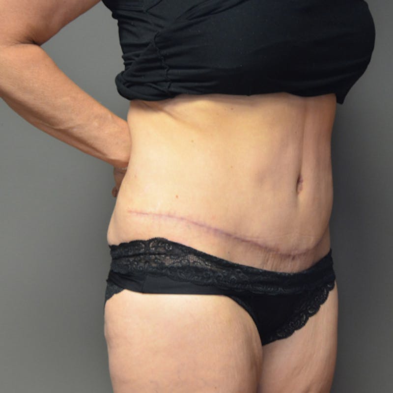 Abdominoplasty (Tummy Tuck) Before & After Gallery - Patient 114720955 - Image 4