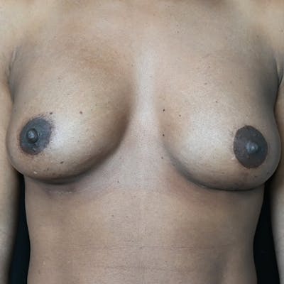Breast Lift Before & After Gallery - Patient 118509270 - Image 2