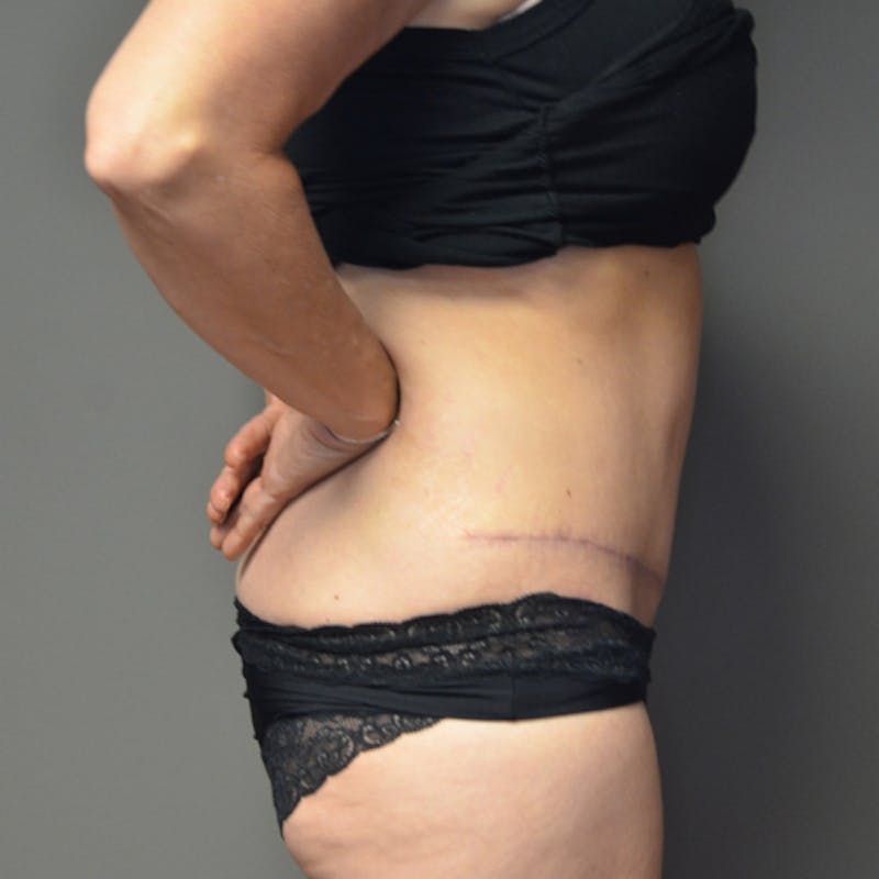 Abdominoplasty (Tummy Tuck) Before & After Gallery - Patient 114720955 - Image 6